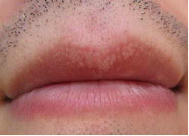 嘴唇上起白斑是什么原因?